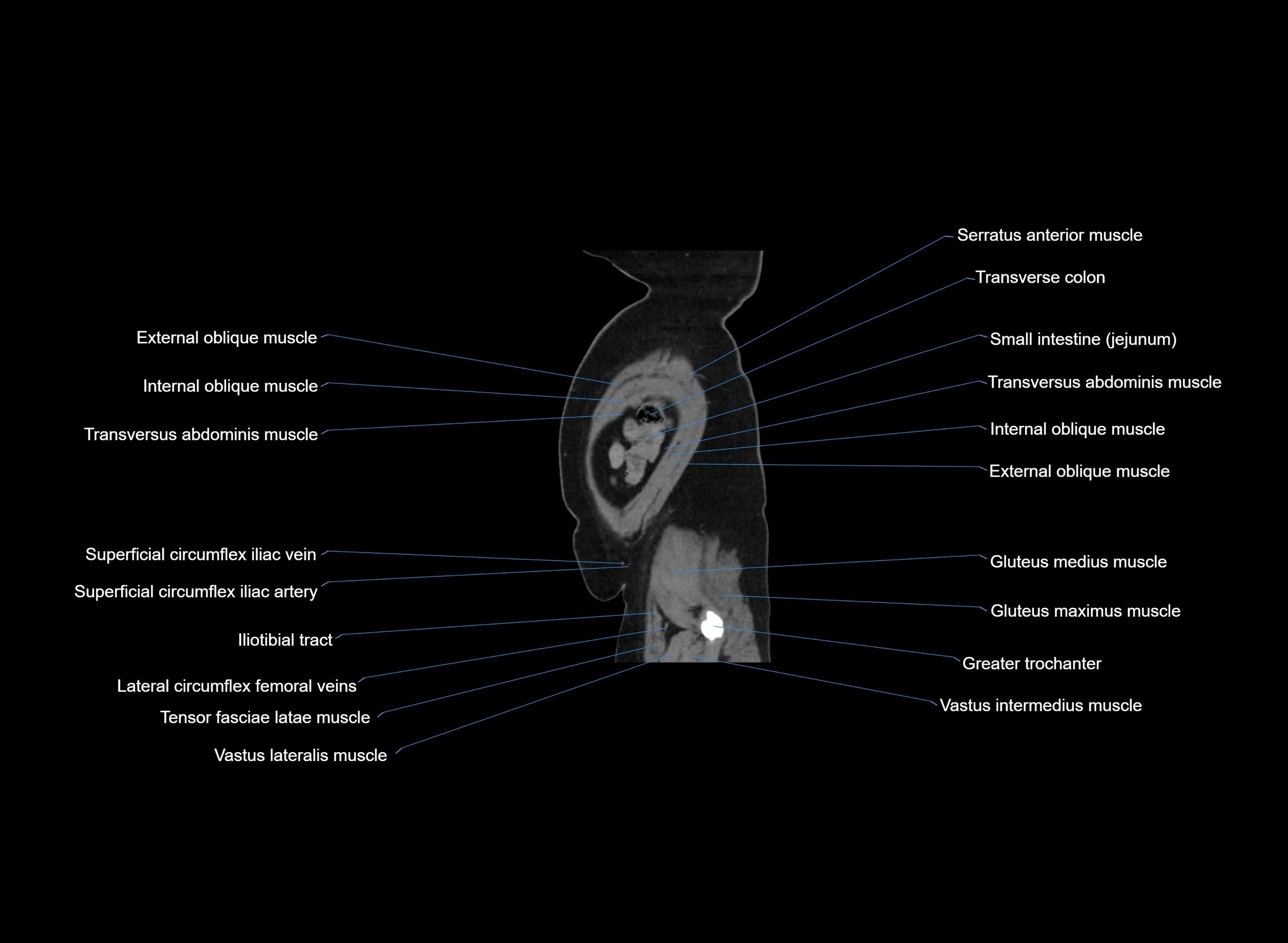 CT Abdomen sagittal cross sectional anatomy labelled radiology image -00010.webp